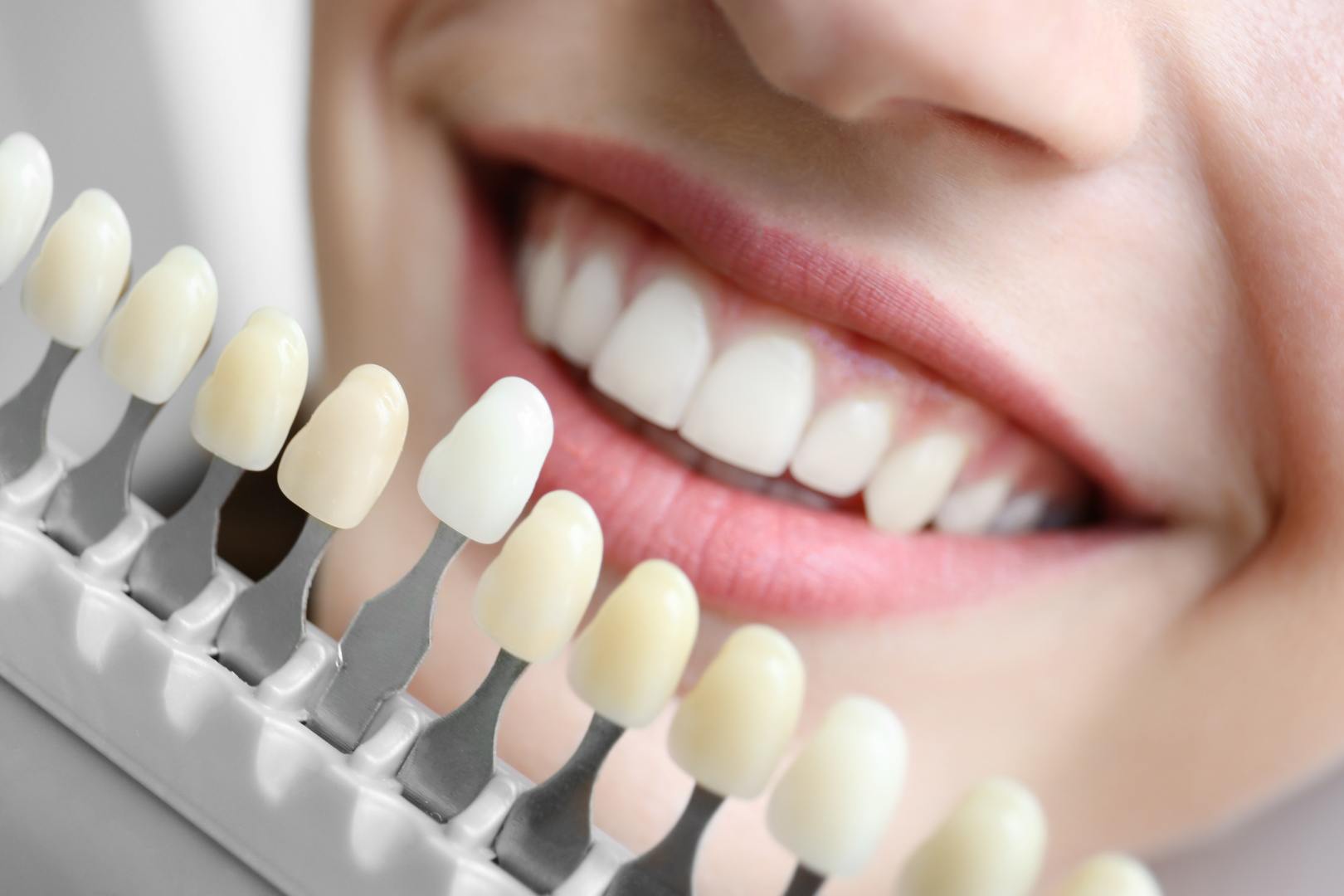Dentista para Clareamento Dental Preco Opcoes e Tudo o que Voce Precisa Saber